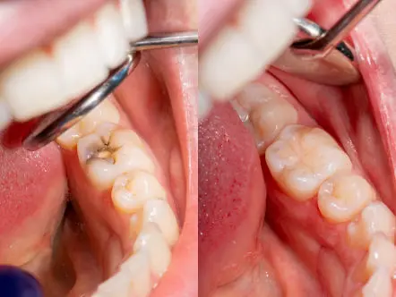Tooth Coloured Filling